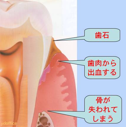 歯周病の初期
