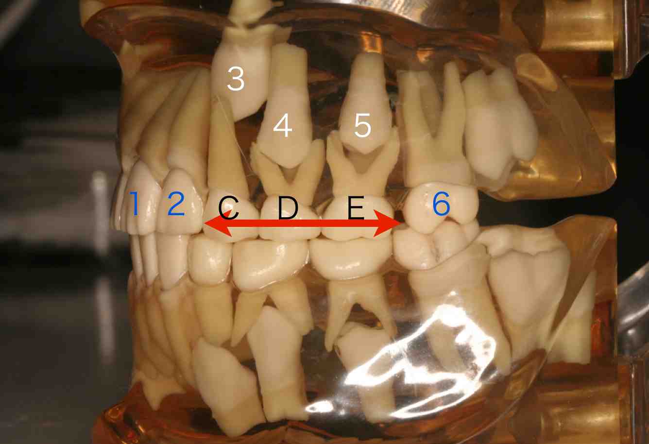 側方歯交換